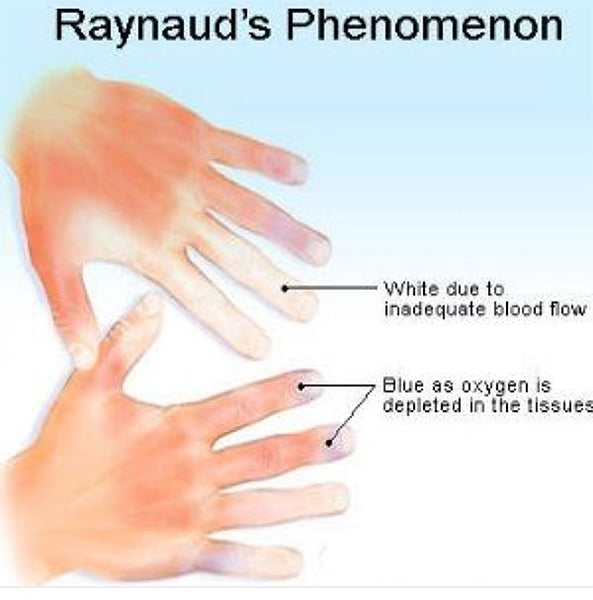 Raynaud's Disease