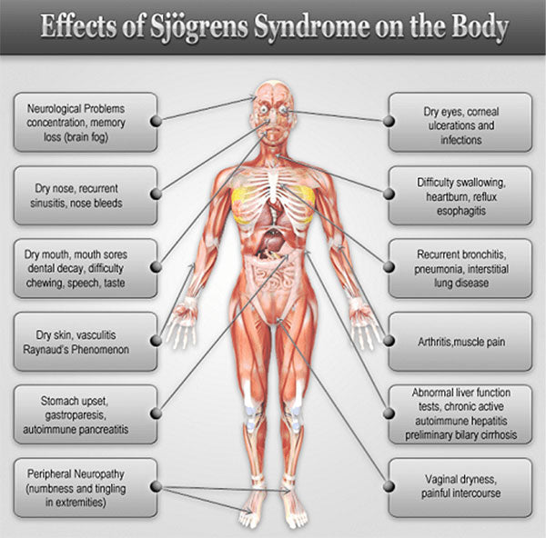 SJOGREN'S DISEASE & IMPORTANCE OF SALIVA